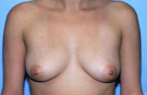 Breast Augmentation Before & After Patient #4953