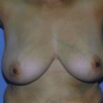 Breast Lift Before & After Patient #5047