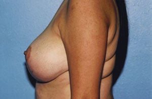 Breast Lift Before & After Patient #5047