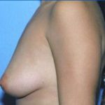 Breast Augmentation Before & After Patient #4953