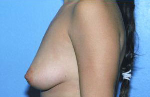 Breast Augmentation Before & After Patient #4953
