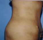 Tummy Tuck Before & After Patient #4889