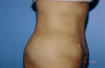 Tummy Tuck Before & After Patient #4889