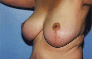 Breast Lift Before & After Patient #5047