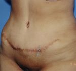 Tummy Tuck Before & After Patient #4889