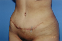 Tummy Tuck Before & After Patient #4889