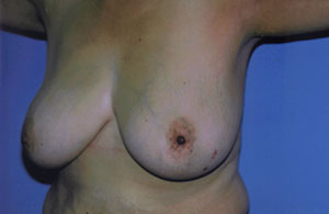 Breast Lift Before & After Patient #5047