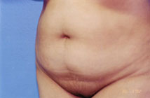 Tummy Tuck Before & After Patient #4889