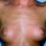 Breast Augmentation Before & After Patient #4962