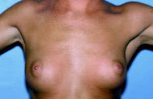 Breast Augmentation Before & After Patient #4962