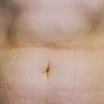 Tummy Tuck Before & After Patient #4899
