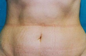 Tummy Tuck Before & After Patient #4899