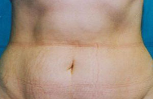 Tummy Tuck Before & After Patient #4899