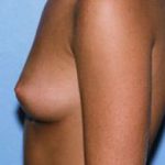 Breast Augmentation Before & After Patient #4962