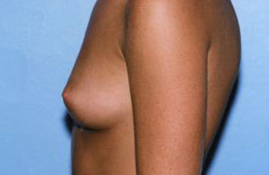 Breast Augmentation Before & After Patient #4962