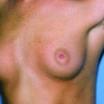 Breast Augmentation Before & After Patient #4962