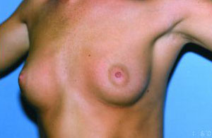 Breast Augmentation Before & After Patient #4962