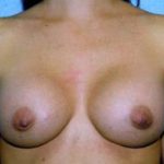 Breast Augmentation Before & After Patient #4969