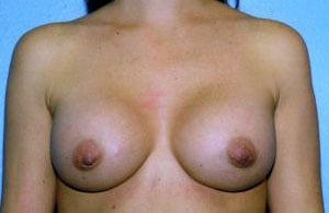 Breast Augmentation Before & After Patient #4969