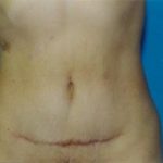 Tummy Tuck Before & After Patient #4904