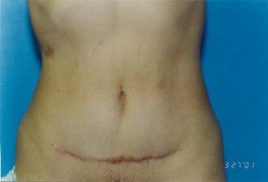 Tummy Tuck Before & After Patient #4904