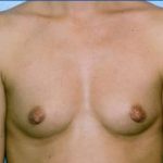 Breast Augmentation Before & After Patient #4969