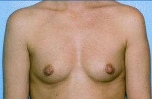 Breast Augmentation Before & After Patient #4969