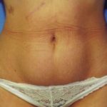 Tummy Tuck Before & After Patient #4904