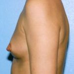 Breast Augmentation Before & After Patient #4969