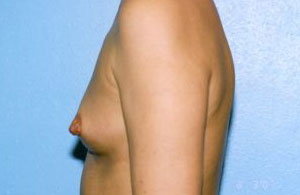 Breast Augmentation Before & After Patient #4969