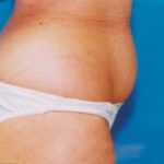 Tummy Tuck Before & After Patient #4904