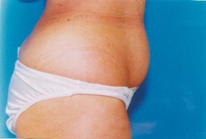 Tummy Tuck Before & After Patient #4904