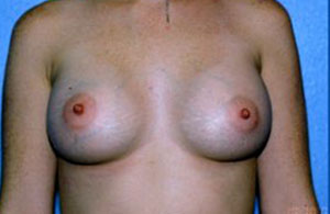 Breast Augmentation Before & After Patient #4976