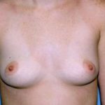 Breast Augmentation Before & After Patient #4976