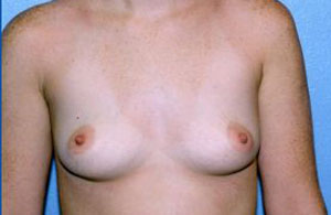 Breast Augmentation Before & After Patient #4976