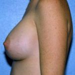 Breast Augmentation Before & After Patient #4976