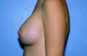 Breast Augmentation Before & After Patient #4976