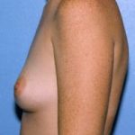 Breast Augmentation Before & After Patient #4976