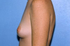 Breast Augmentation Before & After Patient #4976