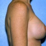 Breast Augmentation Before & After Patient #4976