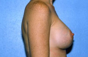 Breast Augmentation Before & After Patient #4976