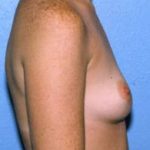 Breast Augmentation Before & After Patient #4976
