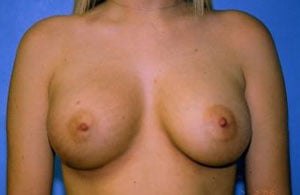 Breast Augmentation Before & After Patient #4983