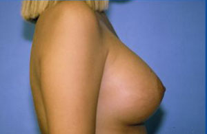 Breast Augmentation Before & After Patient #4983