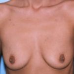 Breast Augmentation Before & After Patient #4988