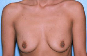 Breast Augmentation Before & After Patient #4988