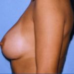 Breast Augmentation Before & After Patient #4988