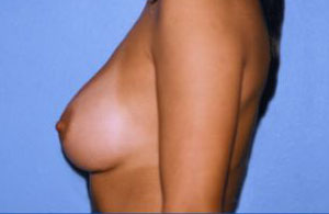 Breast Augmentation Before & After Patient #4988