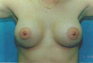 Breast Augmentation Before & After Patient #4993