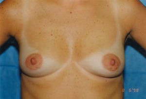 Breast Augmentation Before & After Patient #4993